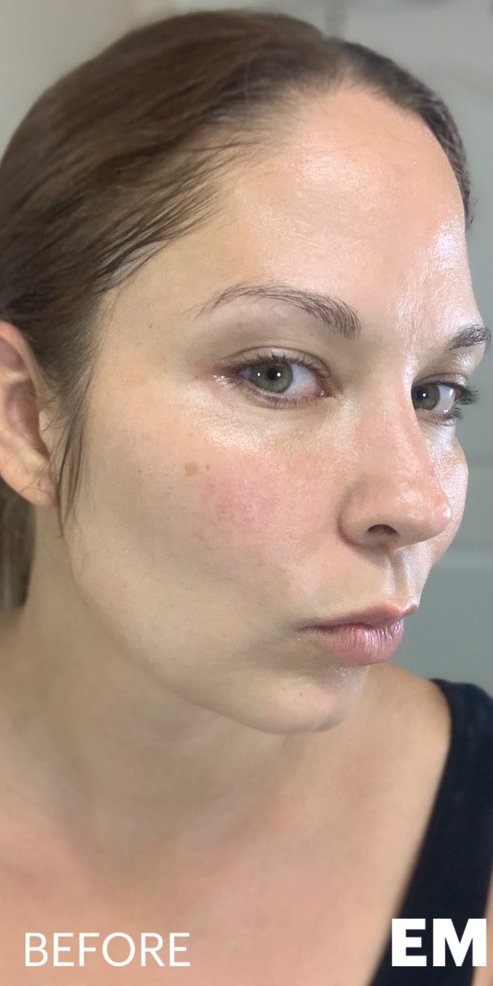 CELESTA Facial Sculpting — Before