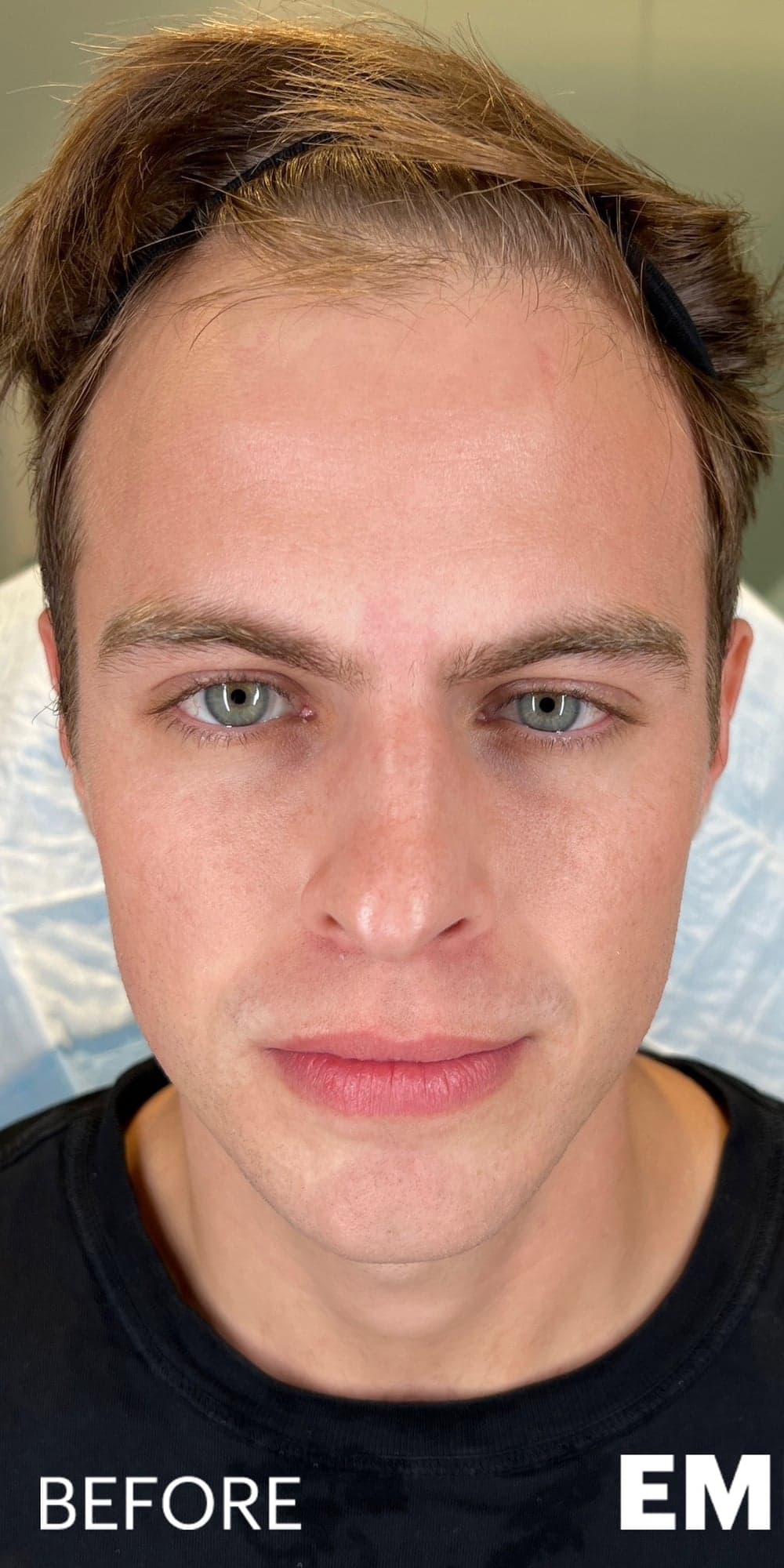 MAXORIS Facial Sculpting — Before