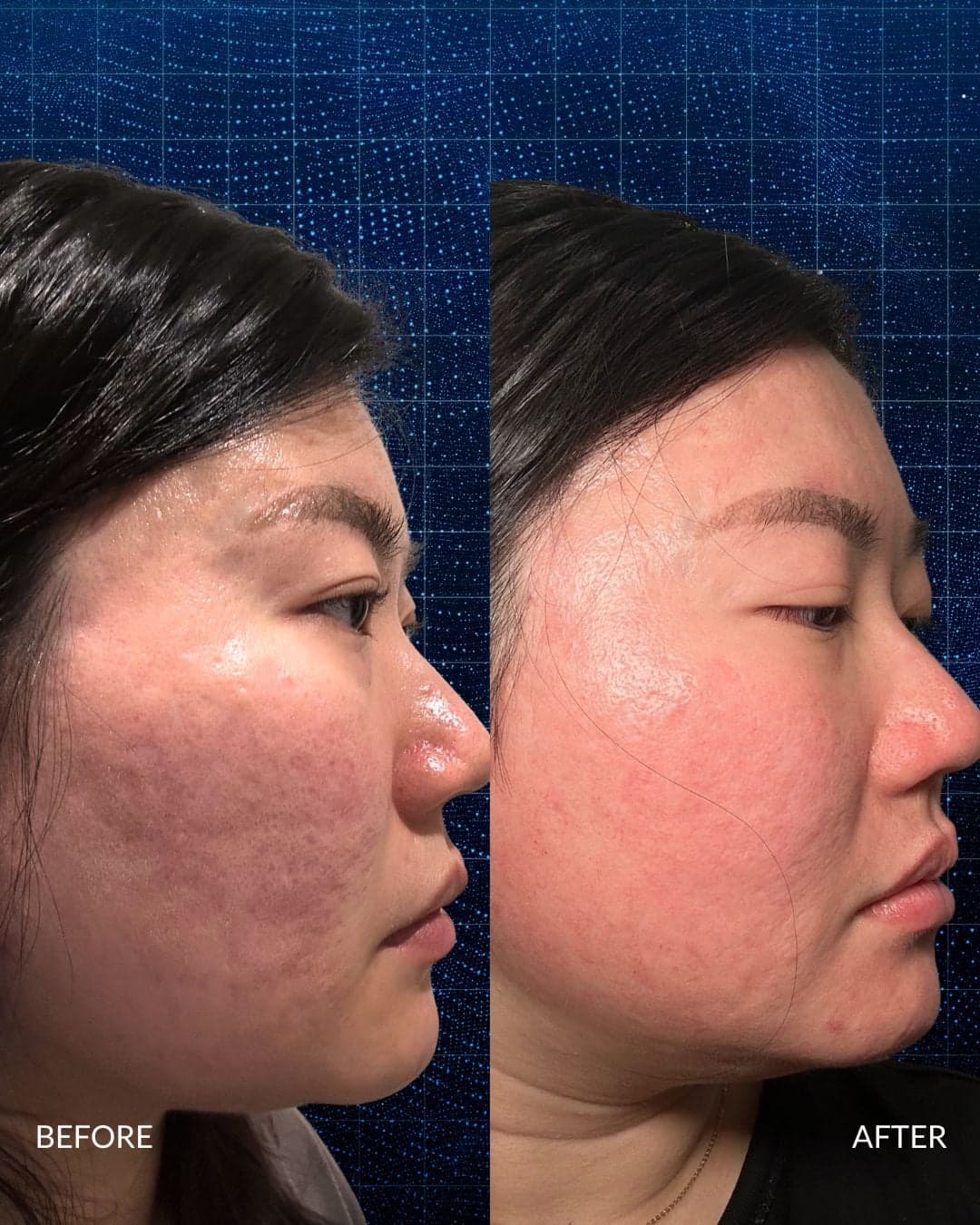 Acne Scar Reconstruction — before and after