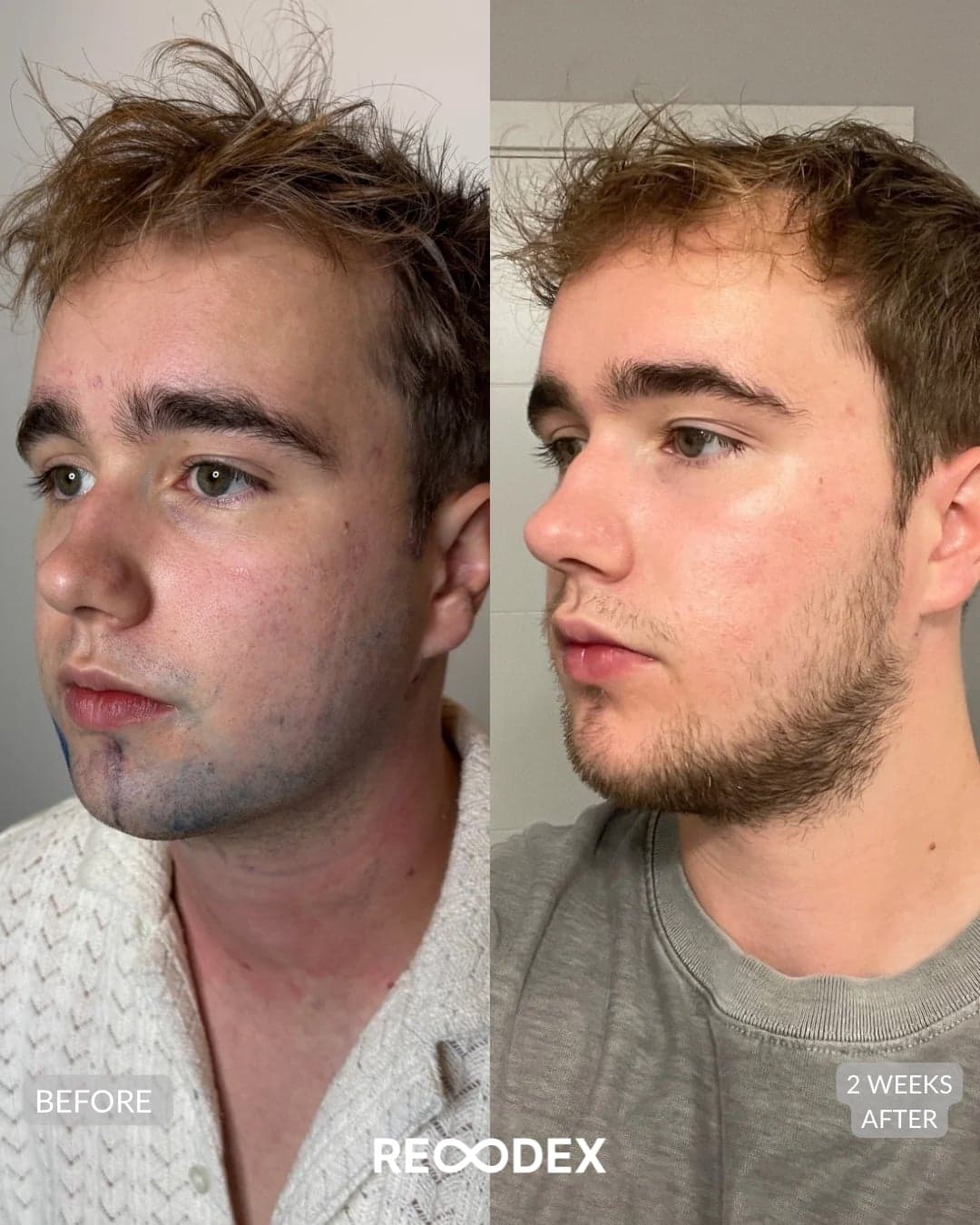 Male Facial Sculpting — before and after