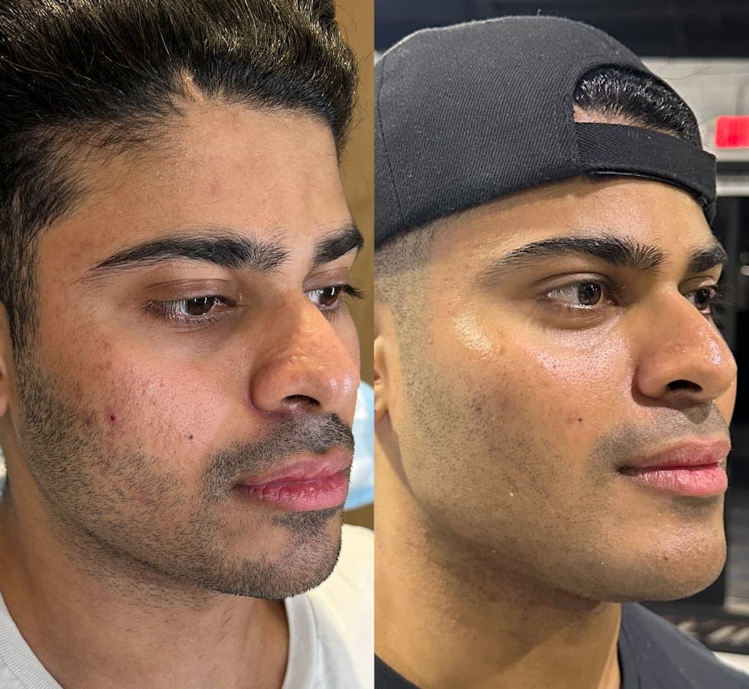 Male Facial Sculpting Before and After