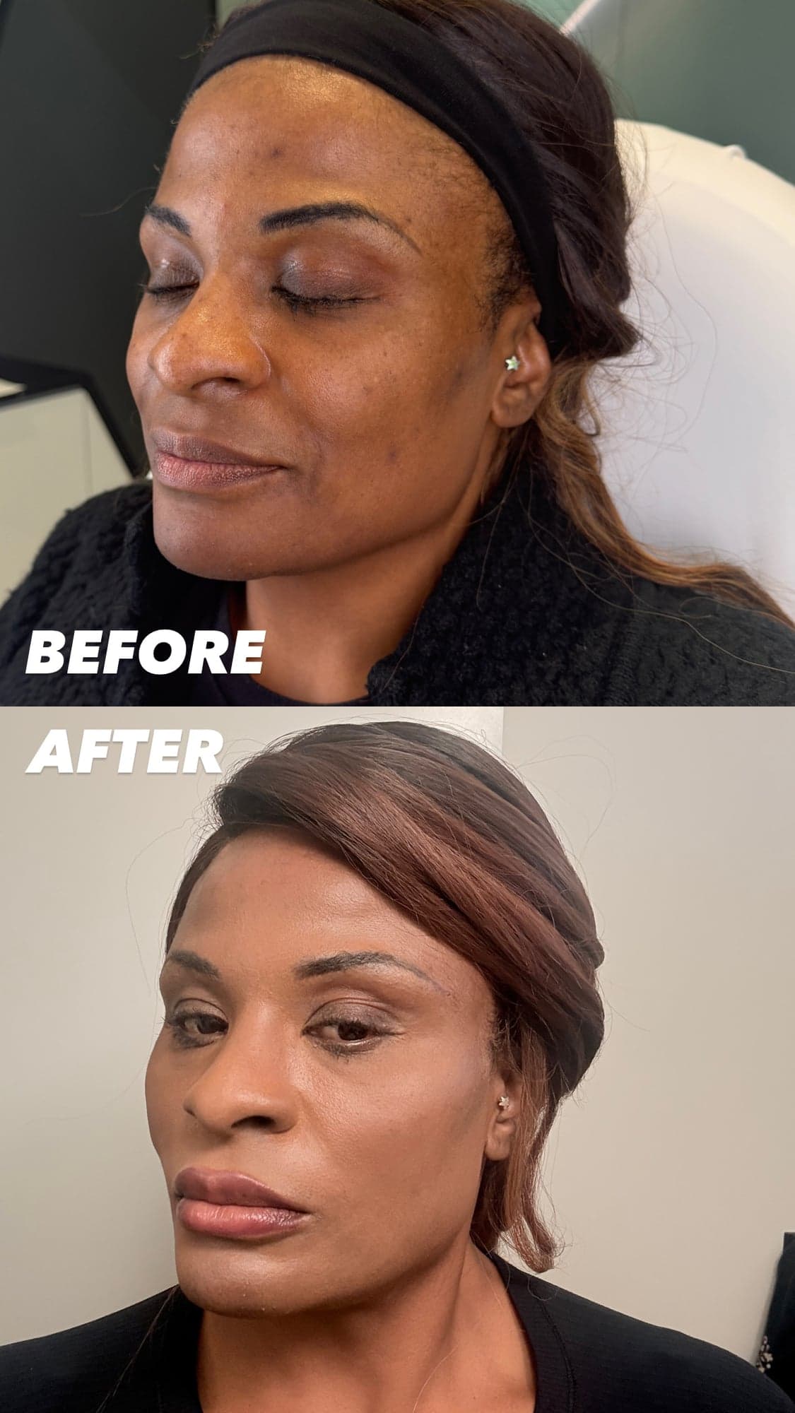 Female Facial Sculpting — before and after
