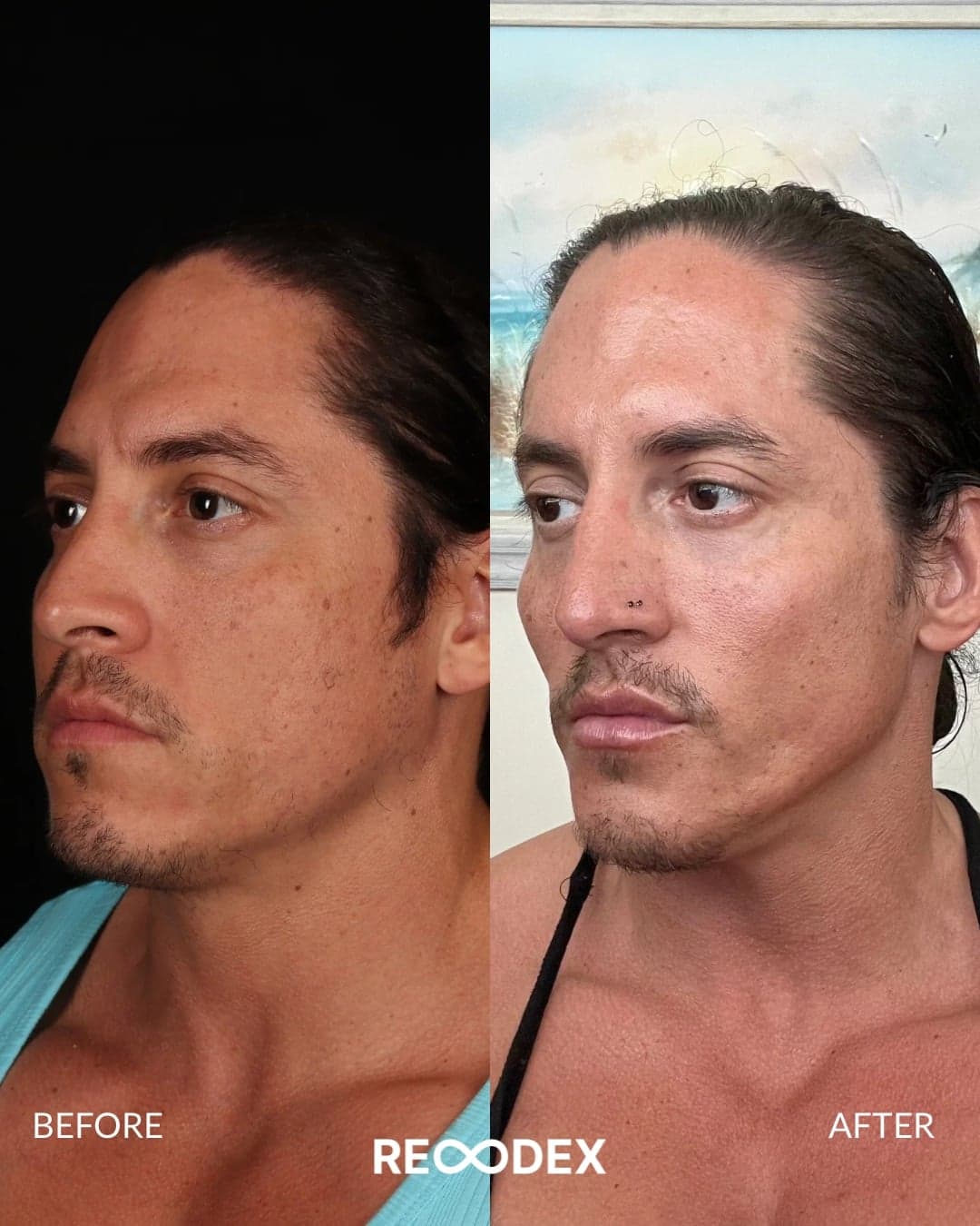 Male Facial Sculpting — before and after