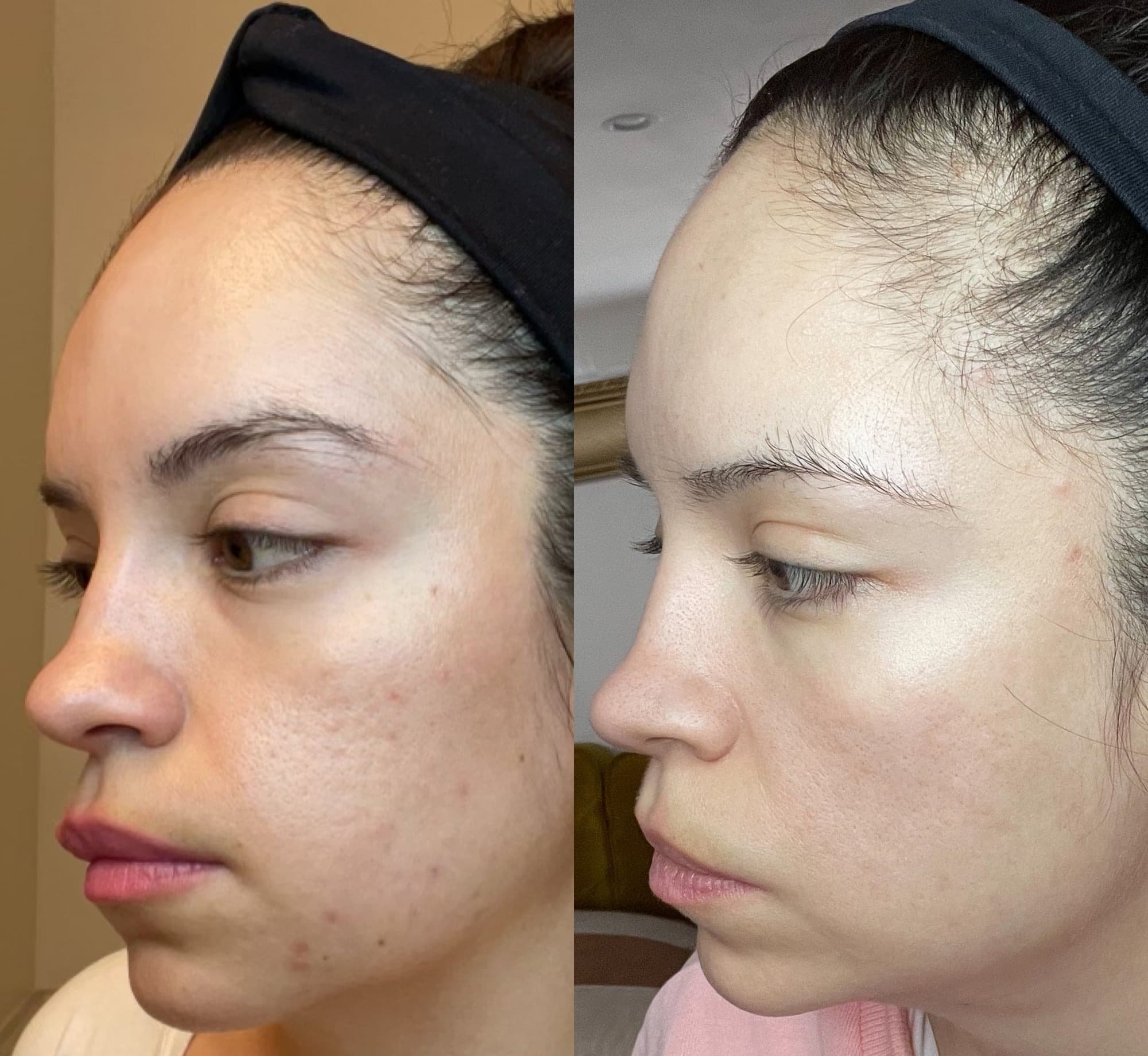 RE:SKN™ Skin Before and After