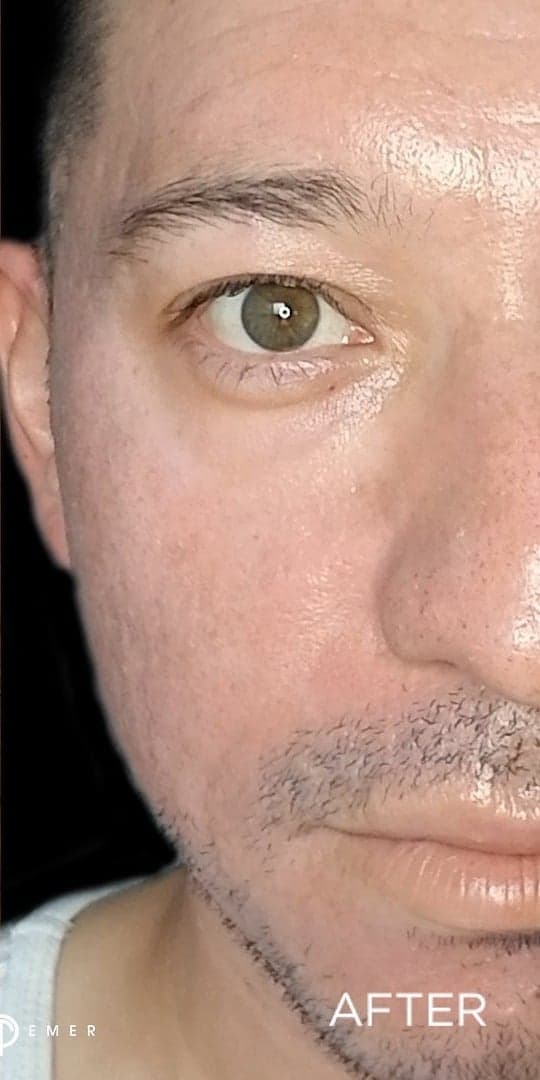 RE:SKN Acne Scars Treatment — After