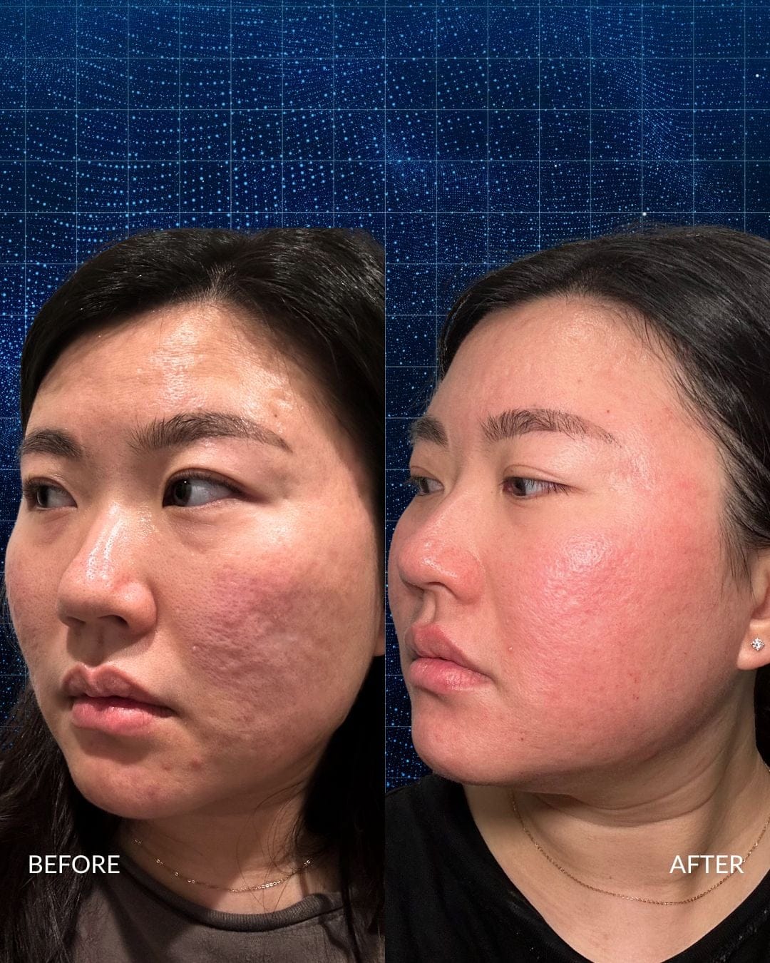 Acne Scar Reconstruction Before and After