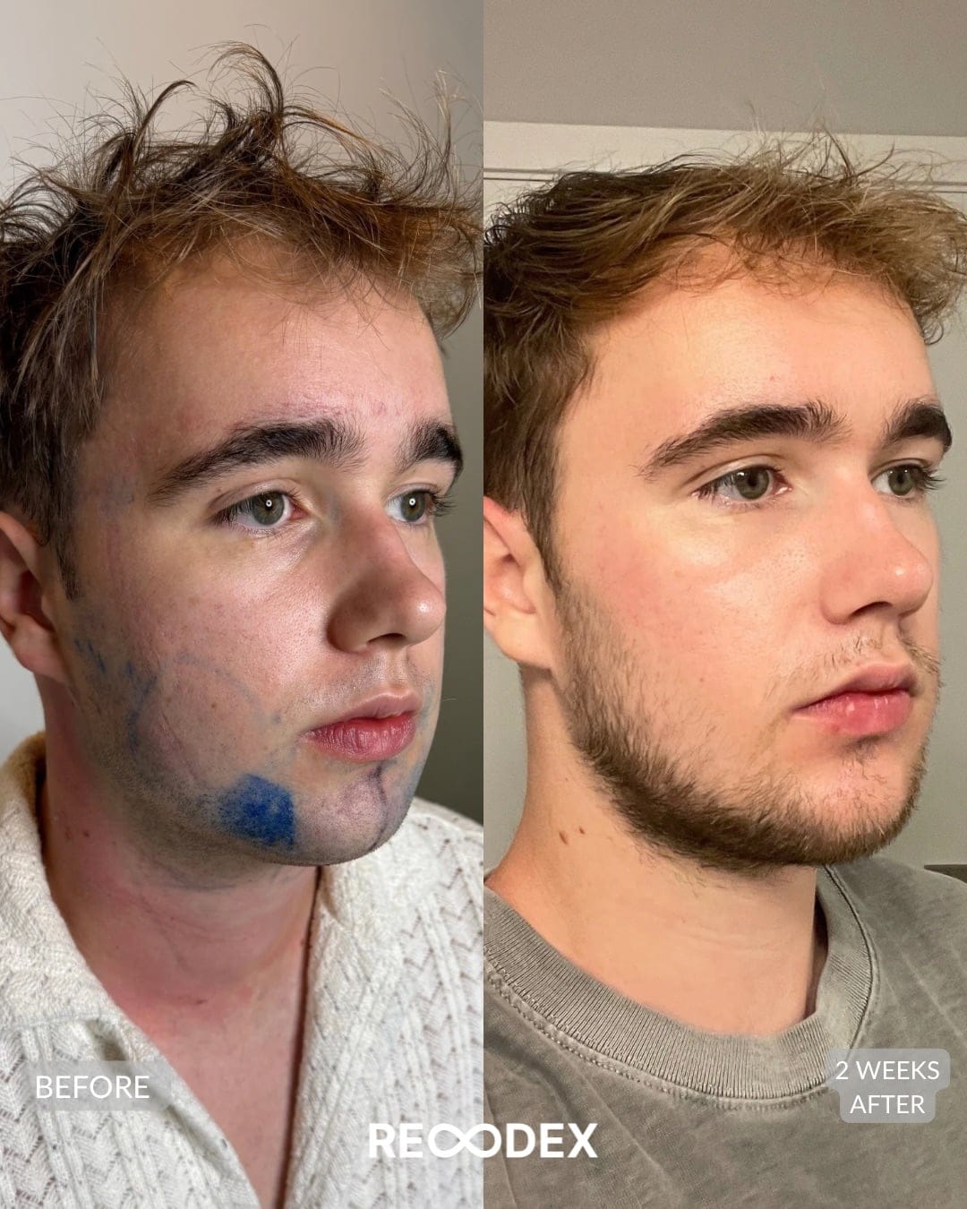 Male Facial Sculpting Before and After