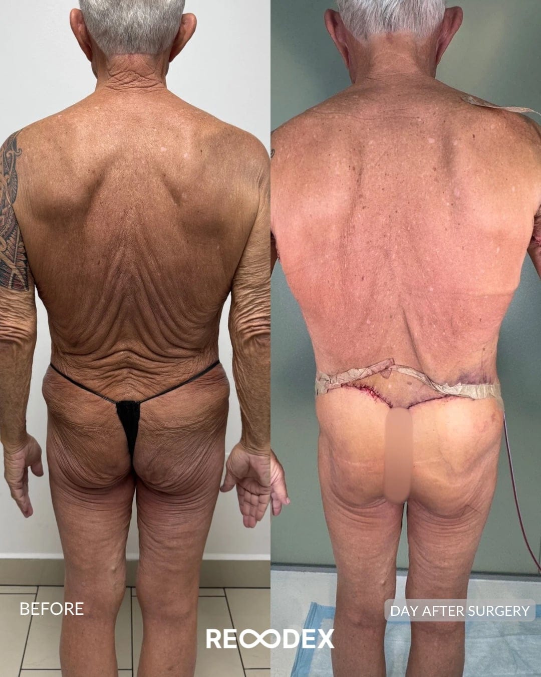 MAXORIS Body Sculpting Before and After