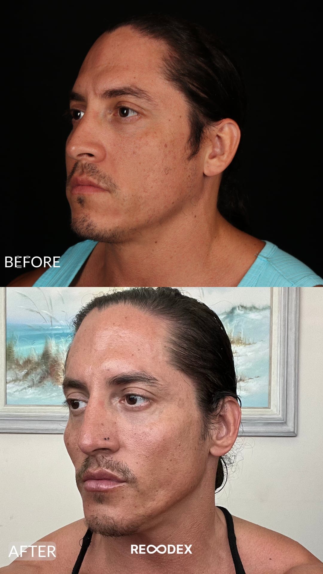 Male Facial Sculpting Before and After
