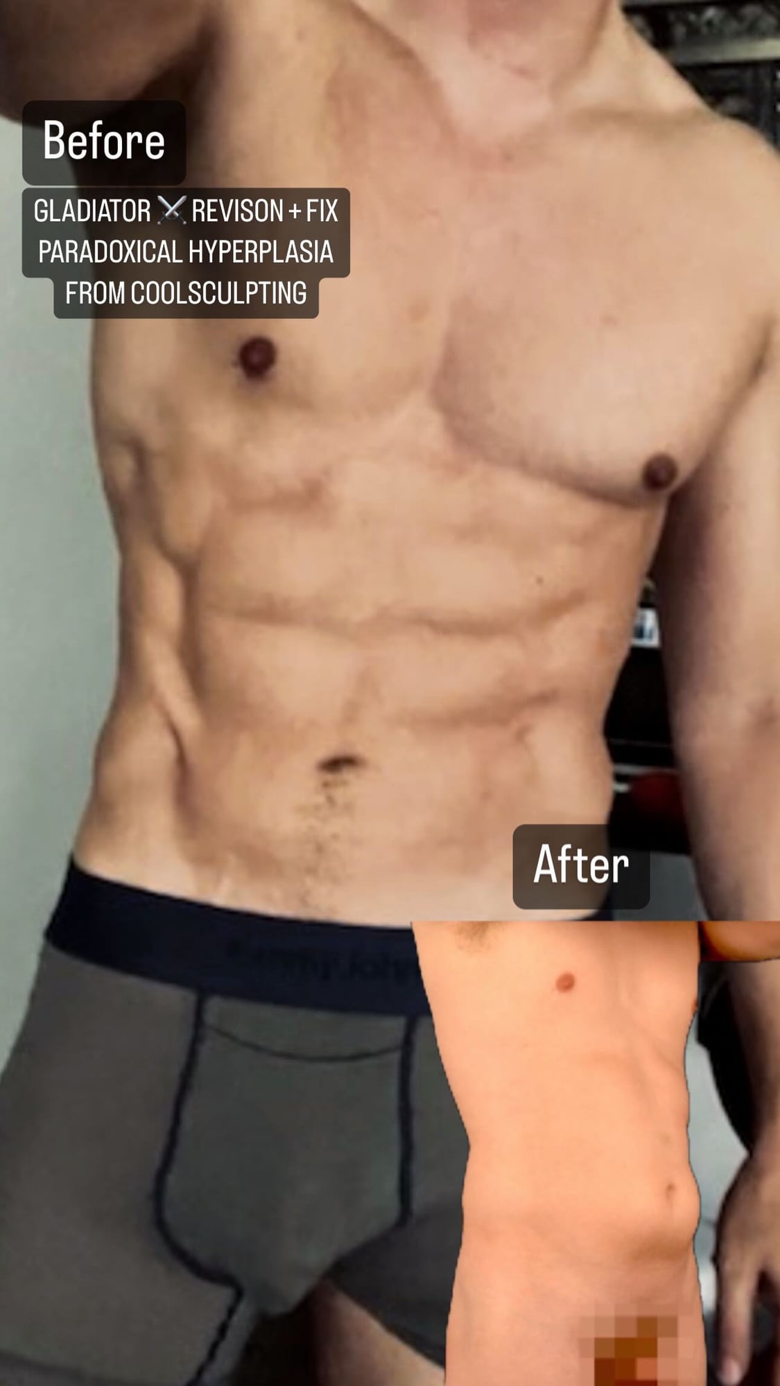 MAXORIS Gladiator Sculpting — body transformation